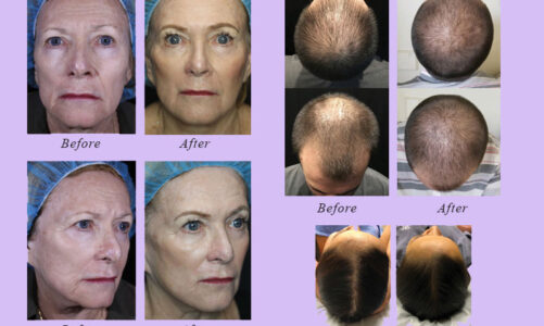 What is Hot in Anti-Aging?